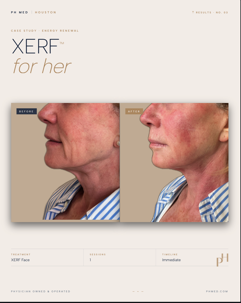 XERF Before and After - for her