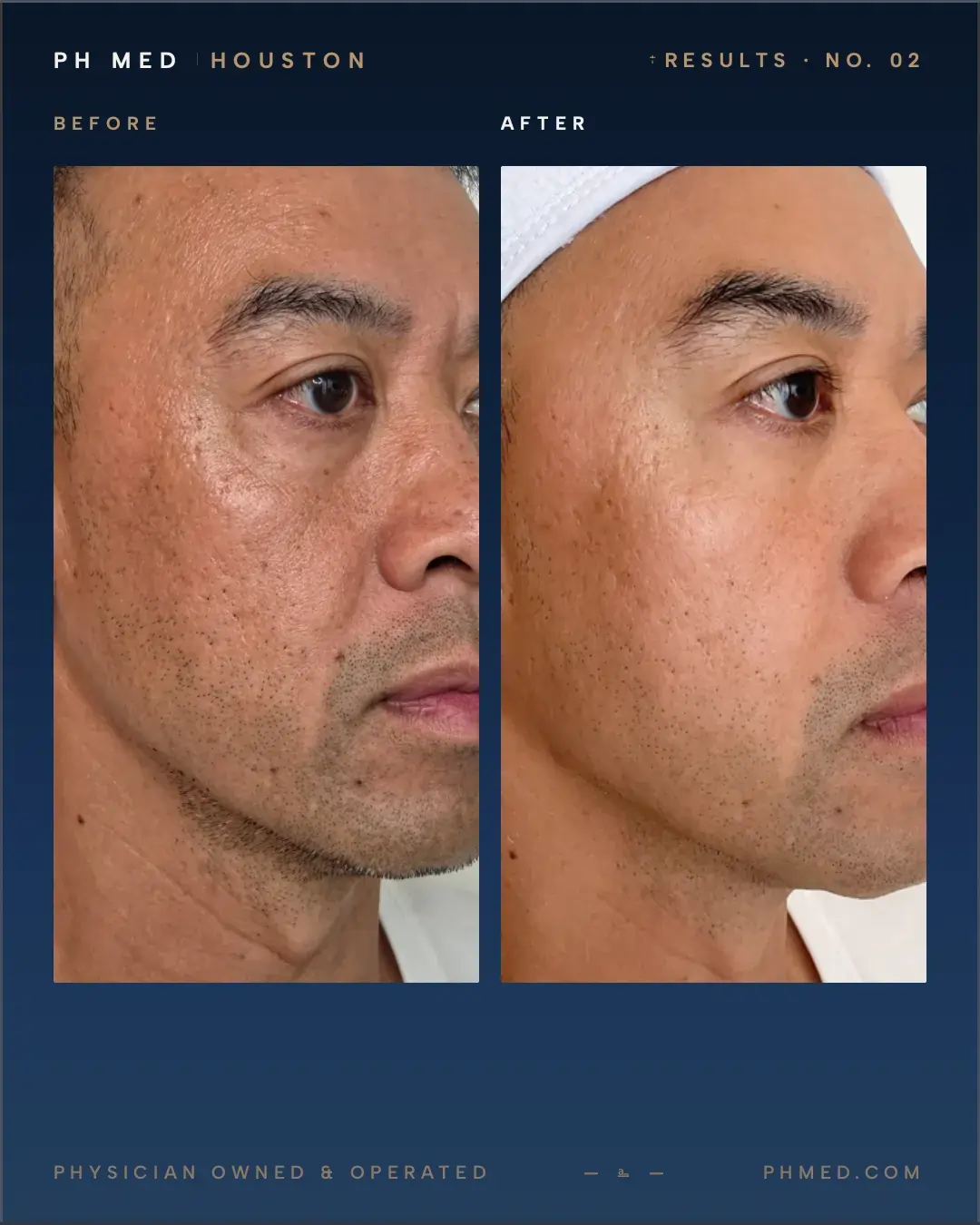 PH Med microneedling Rejuran before and after - skin texture pore refinement close-up