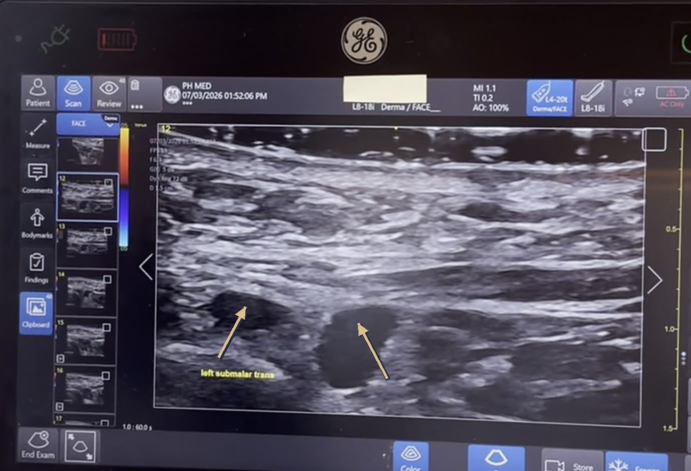 Ultrasound with arrows marking dark anechoic pockets of dermal filler in the left submalar region