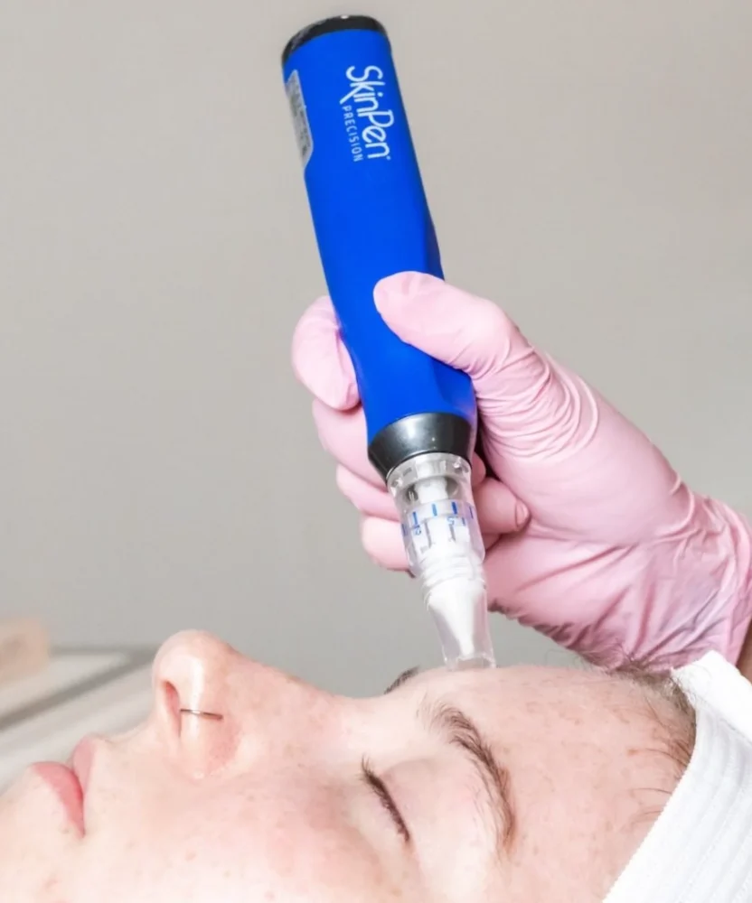 Microneedling with SkinPen in Houston TX